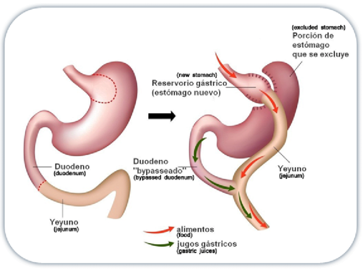 Most Demanded Medical Services in Mexico: Bariatric and Metabolic Surgery