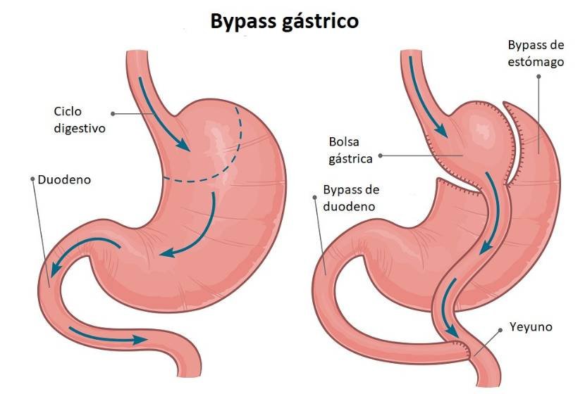 Top 10 most demanded medical procedures in Mexico - Bariatric Surgery